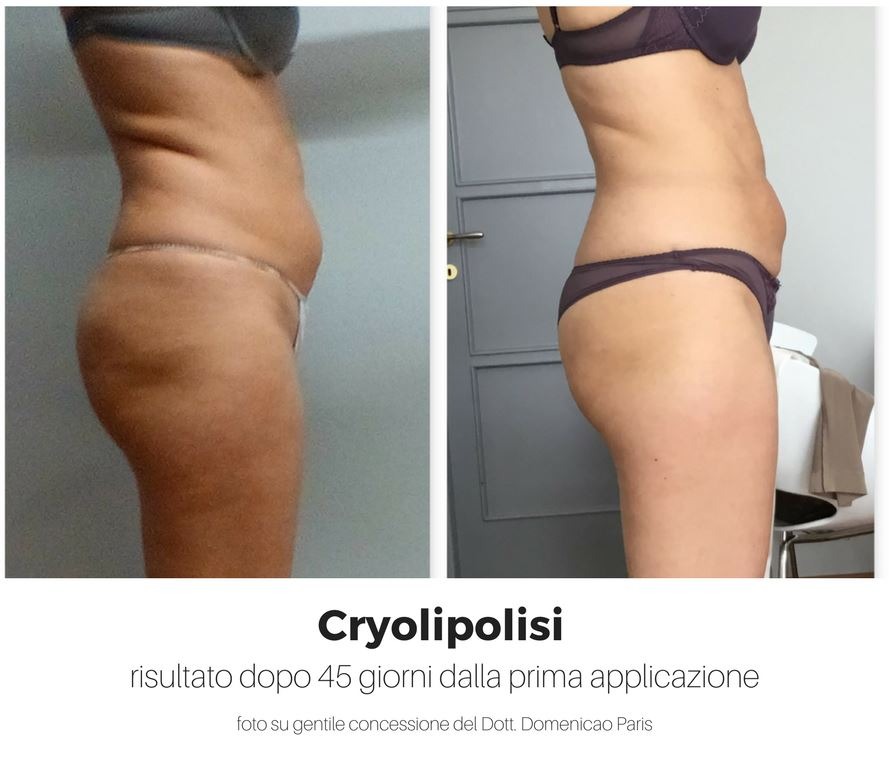 Cryolipolisi: inizia subito per arrivare in forma all'estate!